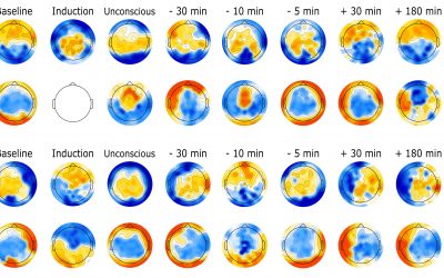 Neural Correlates of Concussion